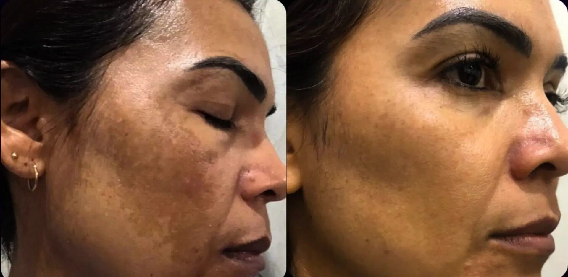 Resultado de tratamento 1