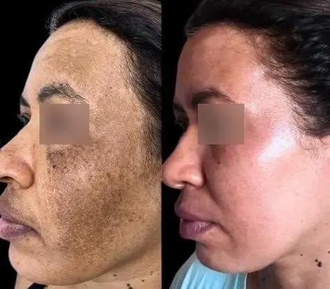 Resultado de tratamento 2
